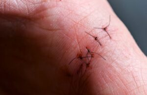 Competência de suturar Competência de suturar