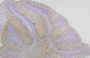 Prémio João Monjardino 2024 distingue trabalho sobre doença de Machado-Joseph
