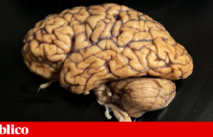 Pela primeira vez, um tratamento atrasa a progressão da doença de Huntington