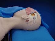 China: homem paralisado controla aparelhos com a mente apenas cinco dias após implante cerebral