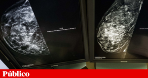 Menopausa cria na mama ambiente favorável ao desenvolvimento de células cancerosas