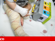 “É uma mochila muito pesada que carregamos a vida toda”: queimaduras continuam a levar crianças às urgências
