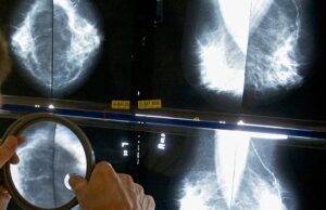 Espanha identifica 111 casos de cancro raro ligado a implantes mamários